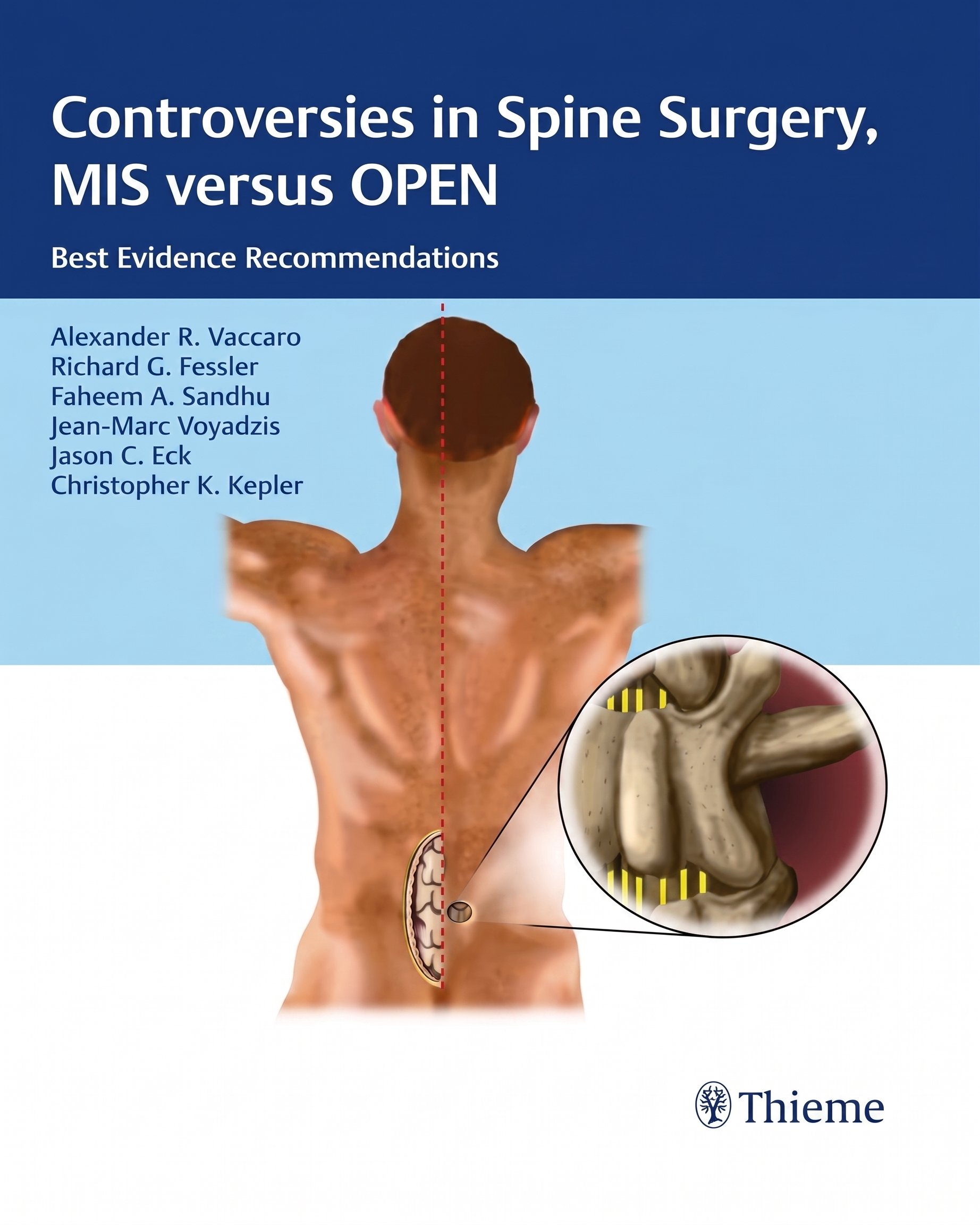 Controversies in Spine Surgery, MIS versus OPEN: Best Evidence Recommendations